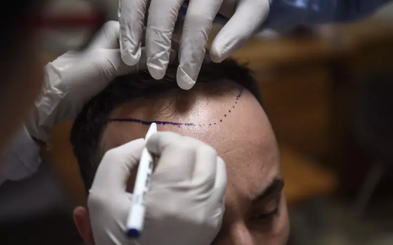 Hair Transplants in Turkey: A Growing Industry