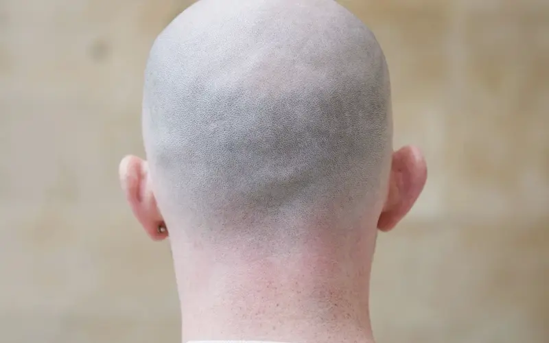 Embracing Baldness: A Journey of Self-Acceptance